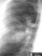 Allergic Bronchopulmonary Aspergillosis